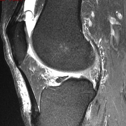 Figure 2 for case Root attachment tear of the posterior horn of the lateral meniscus (RID2763)